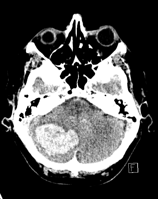 Intracranial haemorrhage in left cerebellar hemisphere due to longstanding hypertension