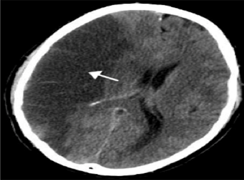Demarcated ischemic stroke of the right hemisphere 