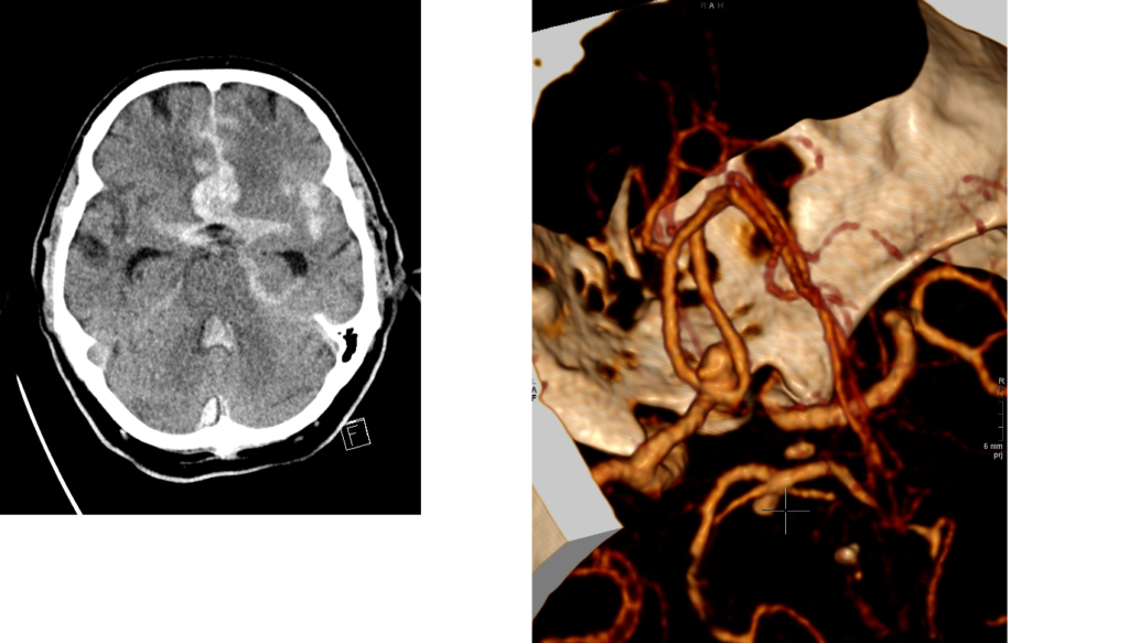 MRI scanns from an aneurysmatic subarachnoid haemorrhage with blood in pentagon. 