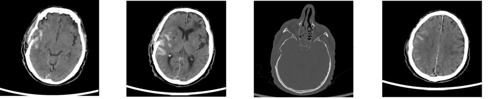MRI scanns from a patient with a severe traumatic brain injury